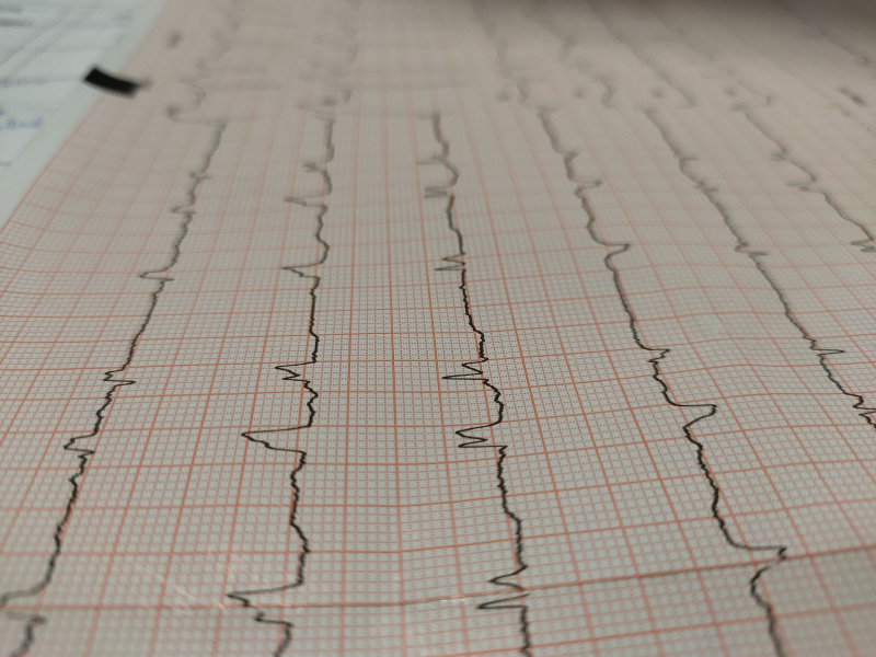   قراءة مخطط كهربية القلب على قطعة من الورق